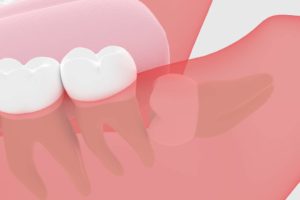 Best wisdom tooth extraction