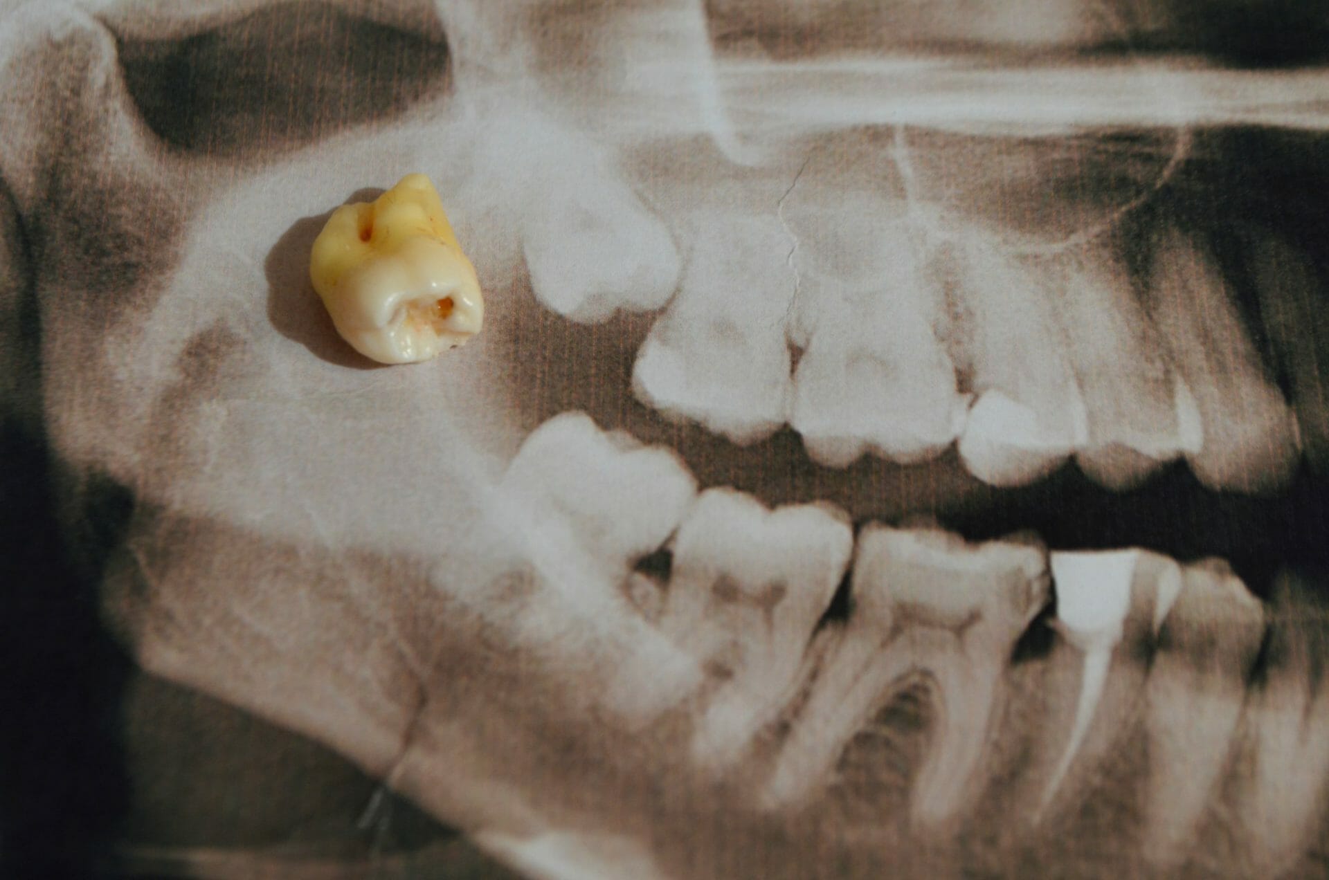Best wisdom tooth removal in South Perth WA