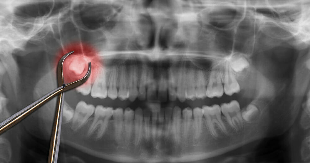 South Perth's wisdom tooth removal in South Perth WA