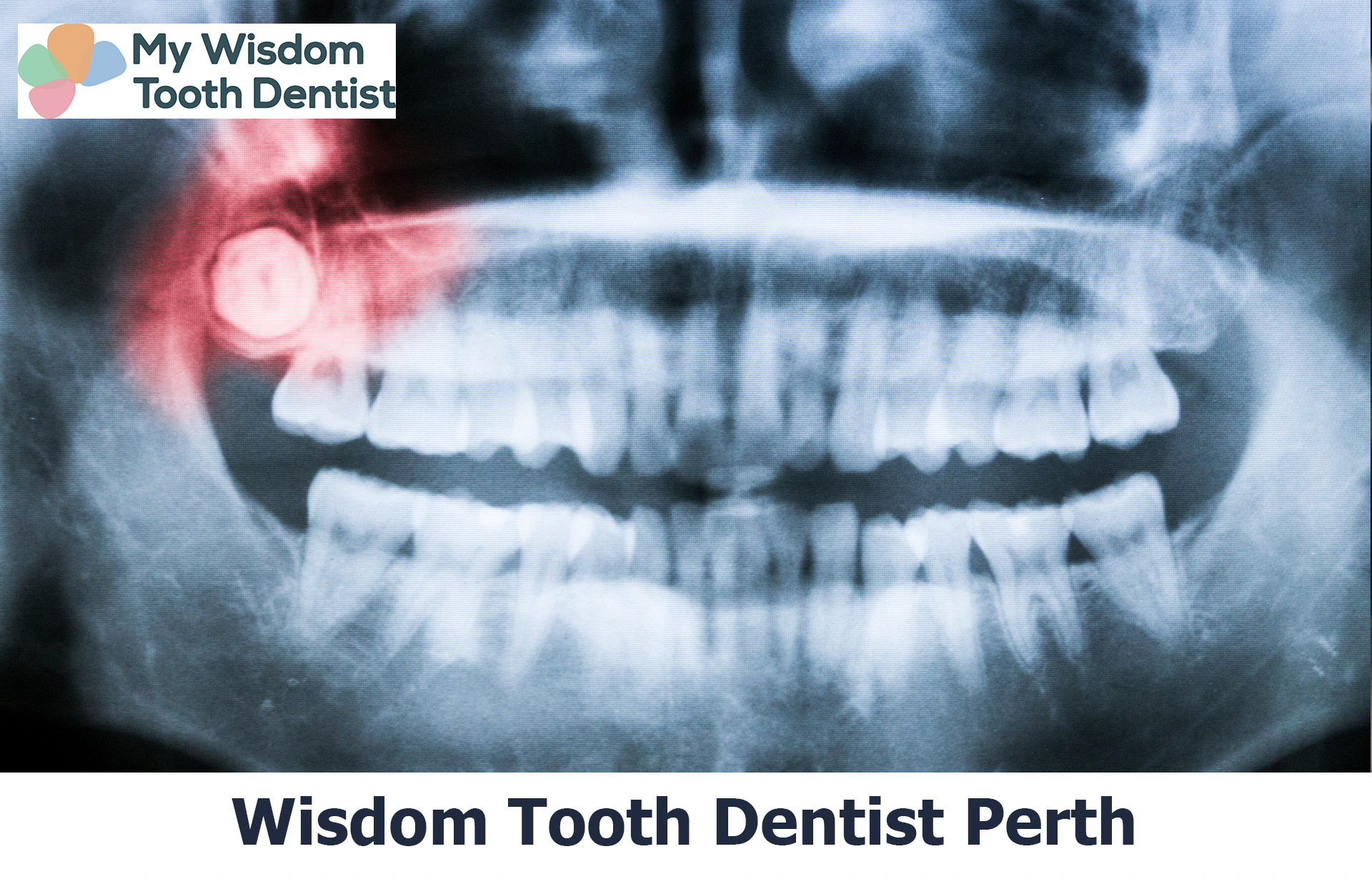 Affordable wisdom teeth removal cost Perth