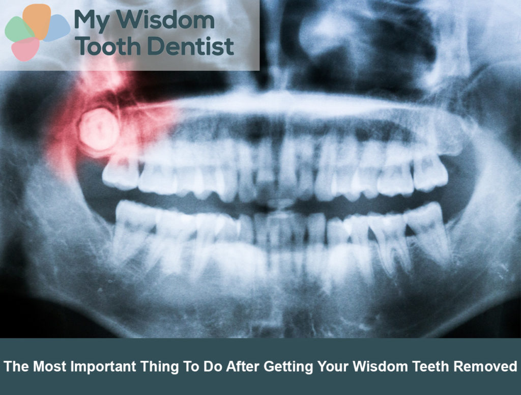 wisdom-tooth-removal-aftercare