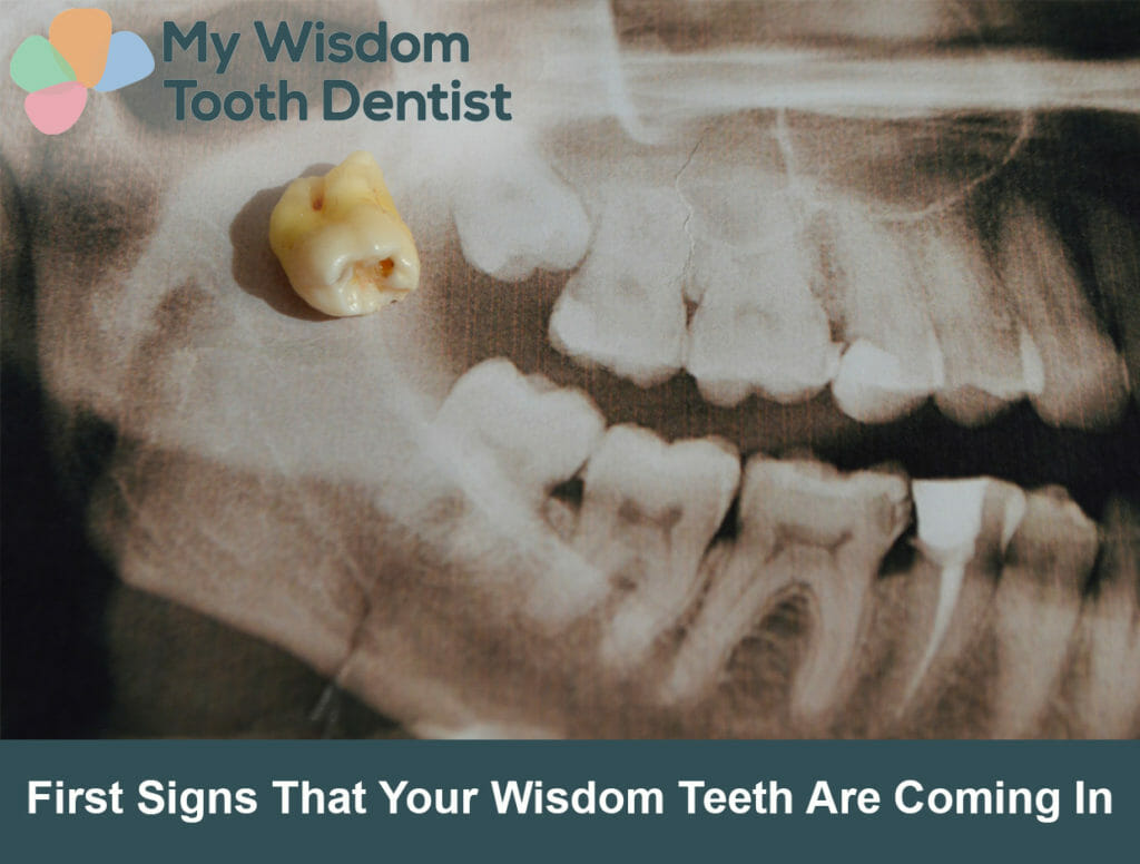 First Signs That Your Wisdom Teeth Are Coming In - Wisdom tooth removal dentist