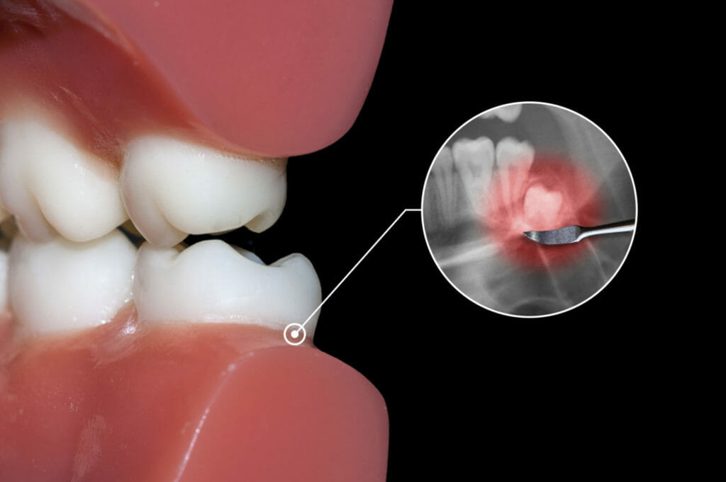 dental toothache, wisdom tooth and molar impact