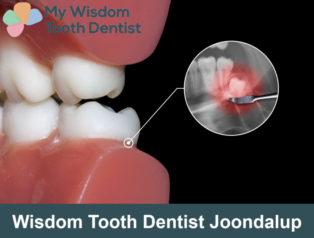 Cheap Wisdom teeth dentist in Joondalup