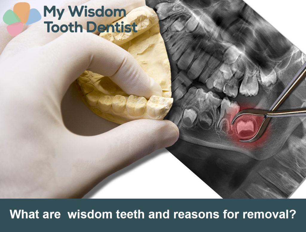 What are wisdom teeth and reasons for removal