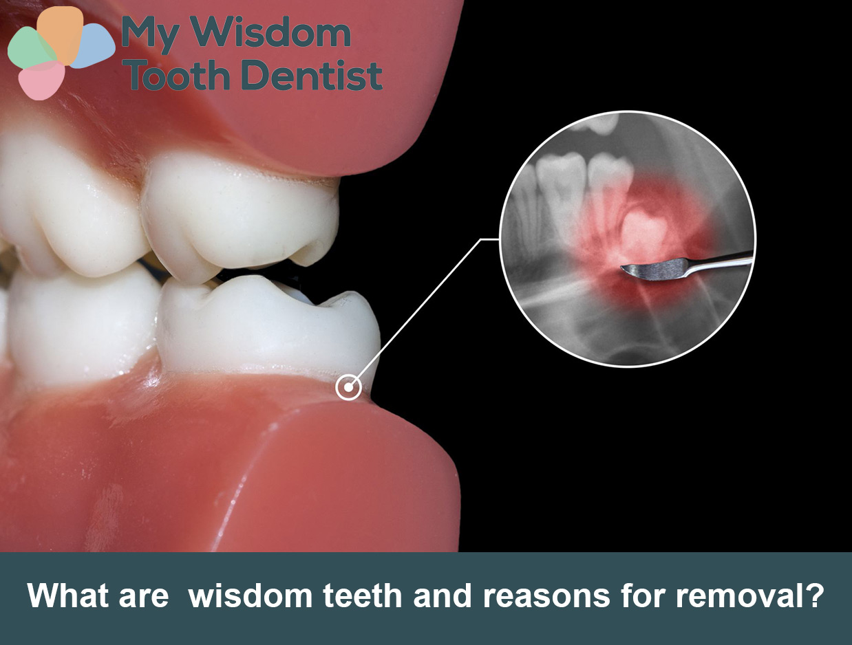 food-to-eat-after-wisdom-teeth-removed-boston-dentist-congress